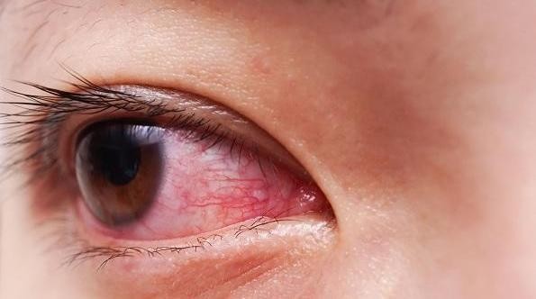 Omicron Belirtisi Adenovirüs Nedir? Adenovirüs Belirtileri Nelerdir?